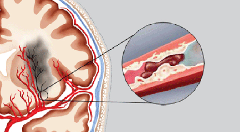 Đột quỵ có phải do hẹp mạch máu não không?