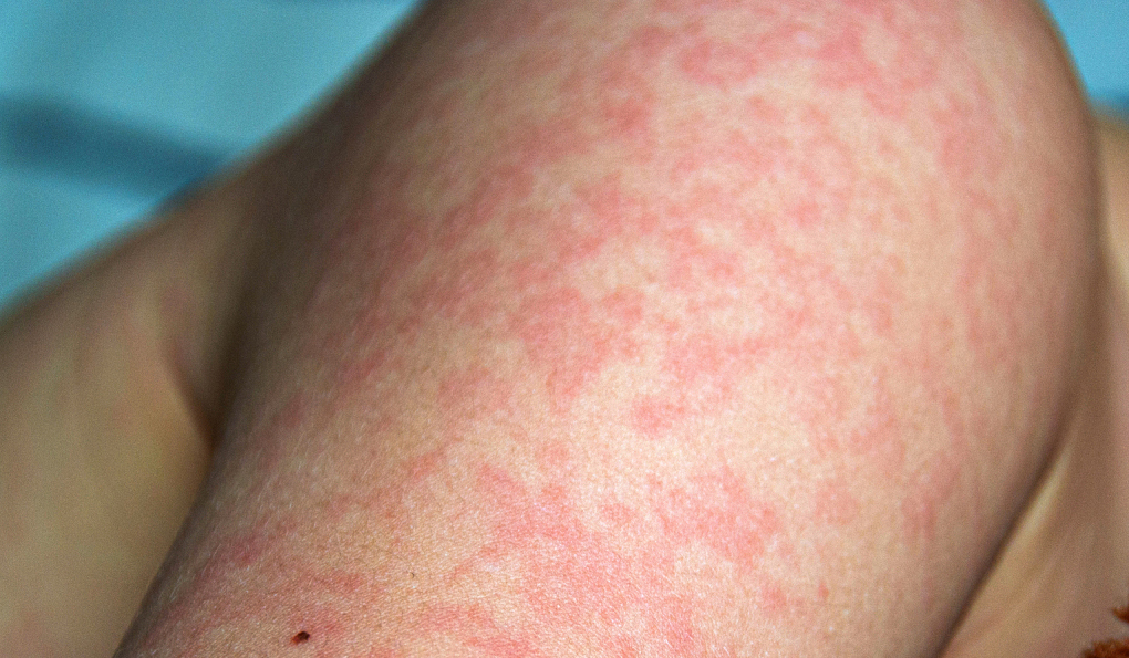 Rubella có trở nặng ở người lớn không?