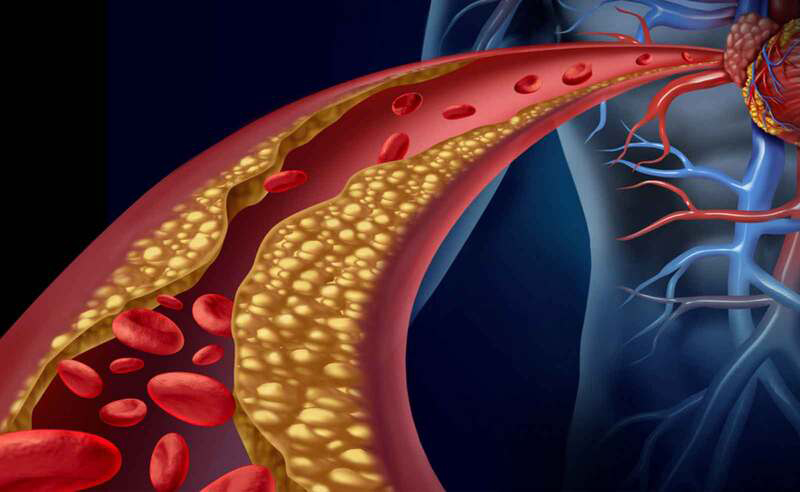 Rối loạn lipid máu là gì?