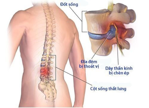 Thoát vị đĩa đệm là gì?