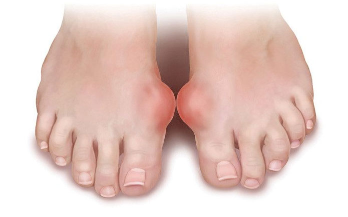 Bệnh gout là gì?