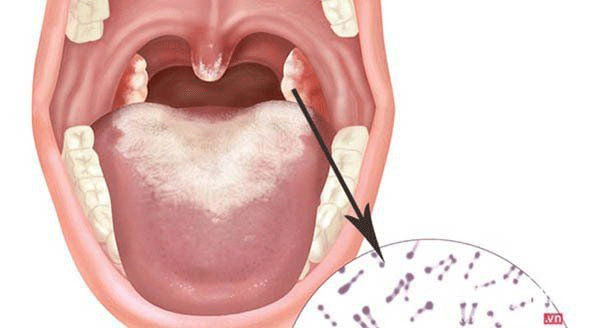 Bệnh Bạch sản - Nhận diện, điều trị và cách bảo vệ sức khỏe răng miệng