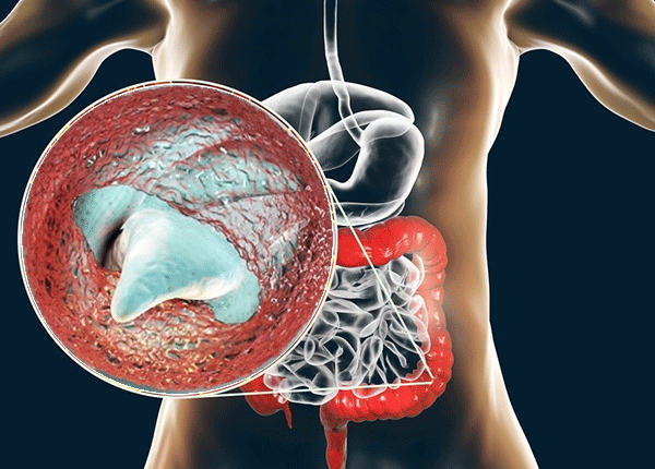 Bệnh Do Cryptosporidium - Nhận Diện Nguyên Nhân, Triệu Chứng Và Cách Phòng Ngừa