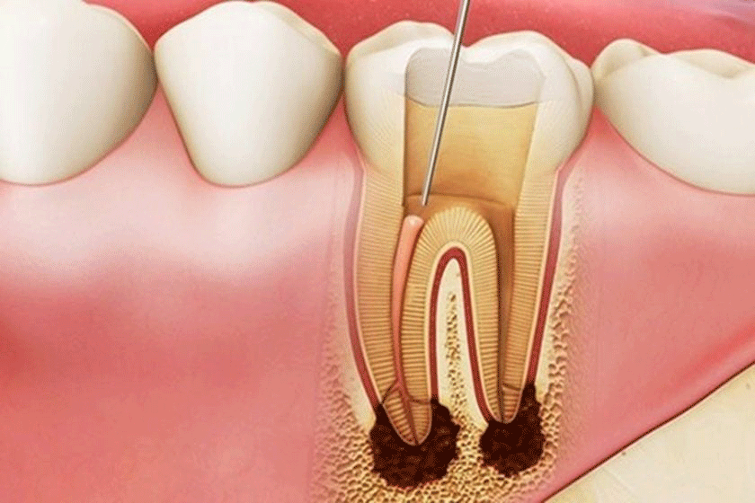 Tại sao phải lấy tủy răng?