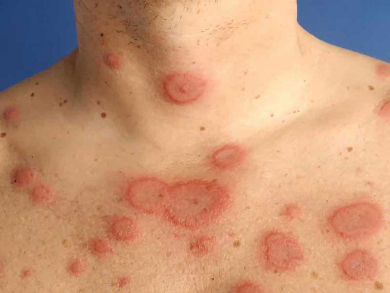 Lupus ban đỏ là gì?