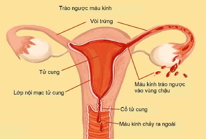 Bệnh Lạc nội mạc tử cung là gì?