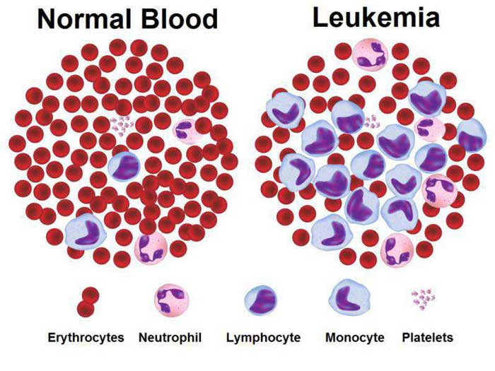 Bệnh Leukemia kinh dòng bạch cầu hạt (CML) là gì?