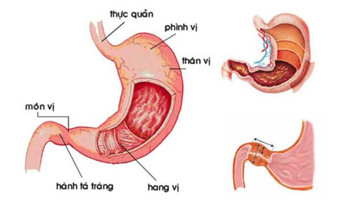 Bệnh Loét hành tá tràng là gì?