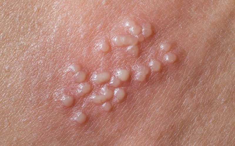 Bệnh Mụn rộp (herpes) sinh dục là gì?