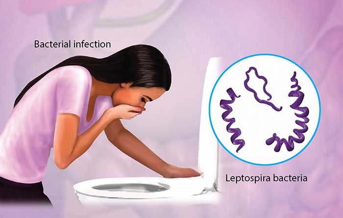 Bệnh Nhiễm xoắn khuẩn vàng da Leptospira là gì?