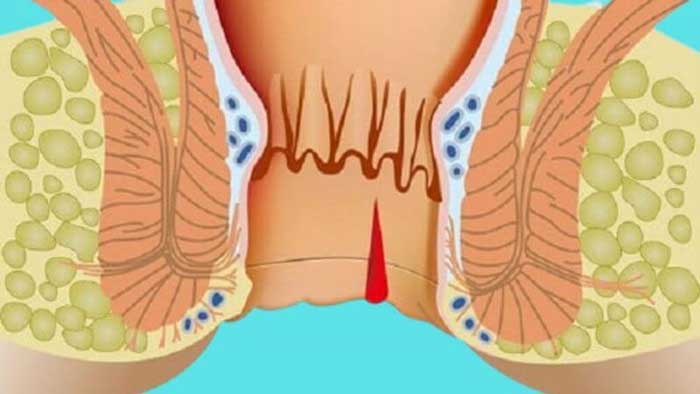 Bệnh Nứt kẽ hậu môn là gì?