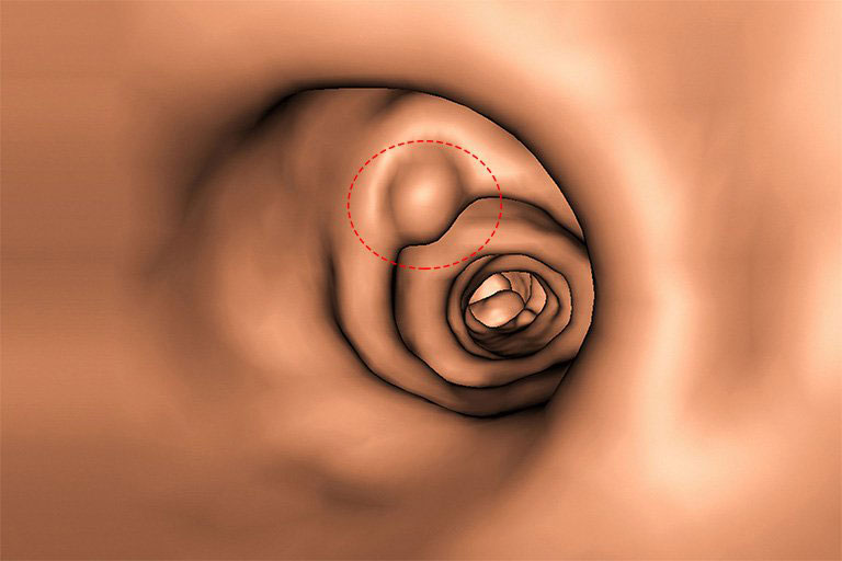 Bệnh Polyp ống tiêu hóa là gì?