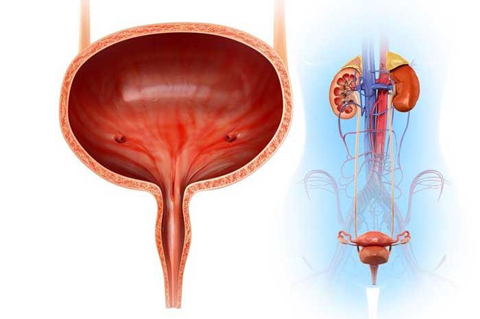 Bệnh Sỏi bàng quang là gì?