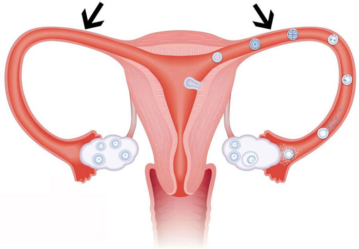Bệnh Tắc ống dẫn trứng là gì?