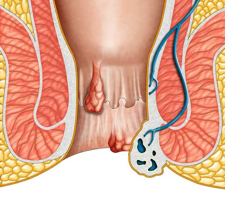 Bệnh Trĩ nội là gì?