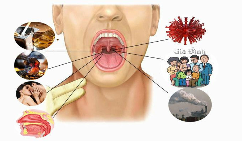 Bệnh Ung thư vòm họng là gì?