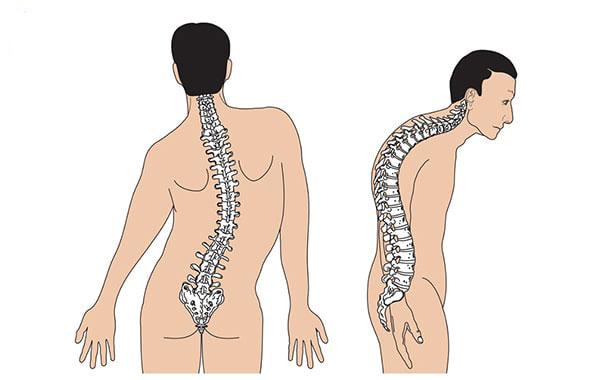 Bệnh Vẹo cột sống là gì?