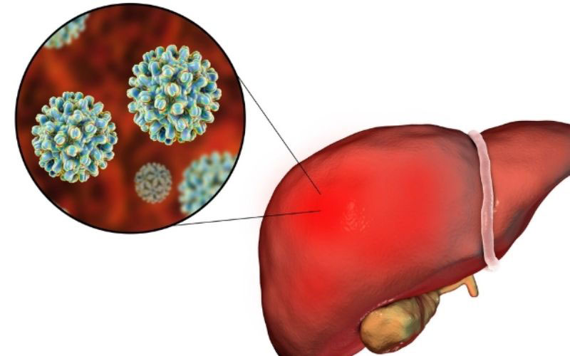 Bệnh Viêm gan B là gì?
