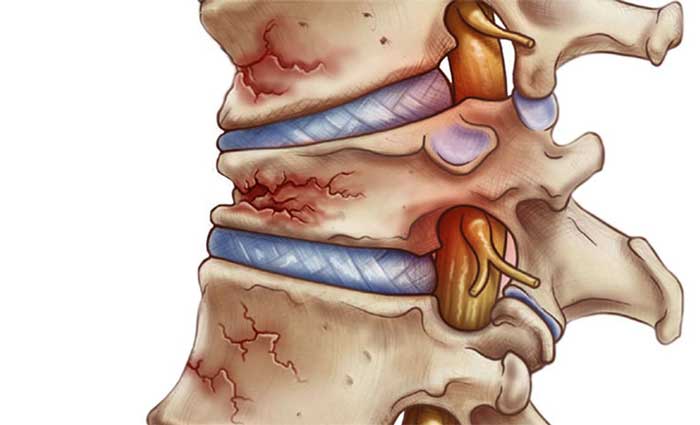 Bệnh Xẹp đốt sống là gì?