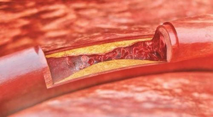 Bệnh Xơ vữa động mạch là gì?