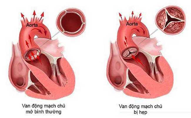 Hẹp động mạch phổi là gì?