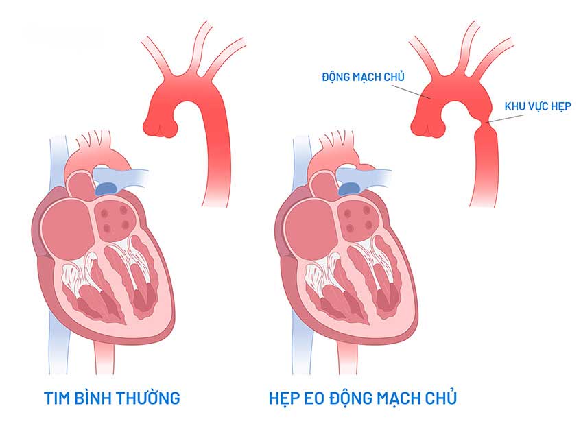 Hẹp eo động mạch chủ là gì?