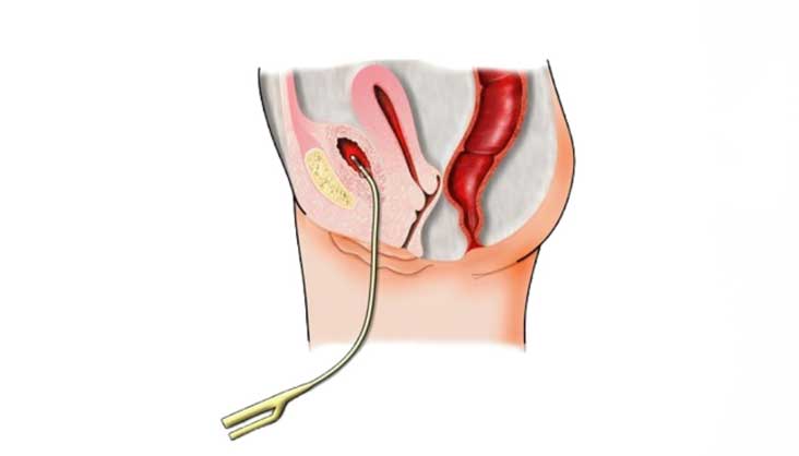 Hẹp niệu đạo là gì?