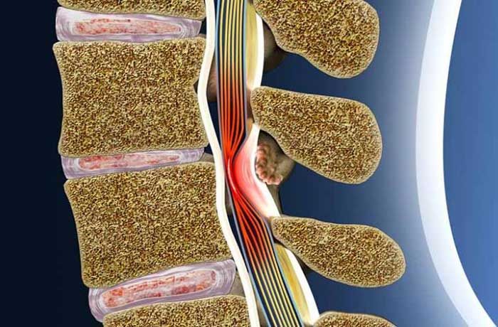 Hẹp ống sống là gì?