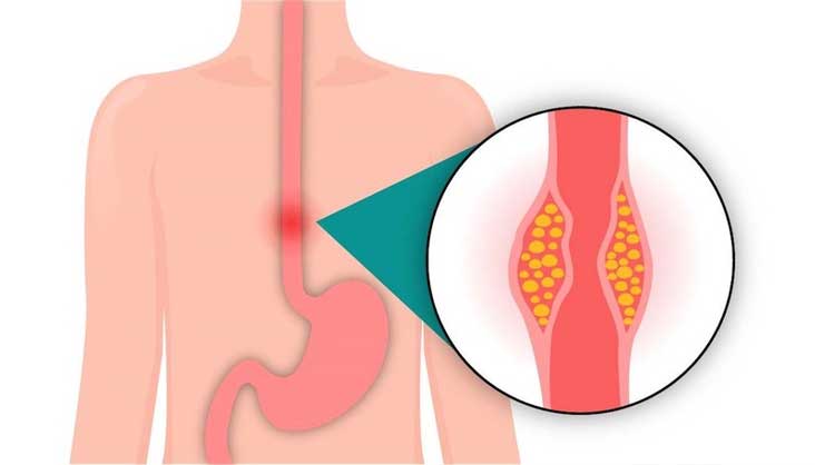 Hẹp thực quản là gì?