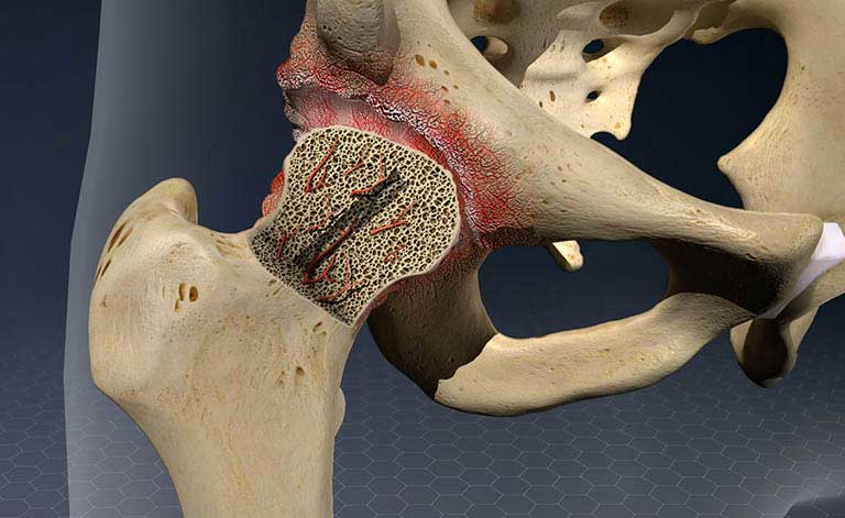 Hoại tử chỏm xương đùi là gì?