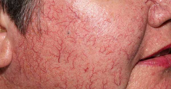 Hội chứng Carcinoid là gì?