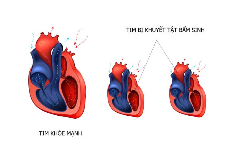 Hội chứng Eisenmenger là gì?