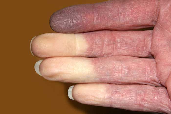 Hội chứng Raynaud là gì?