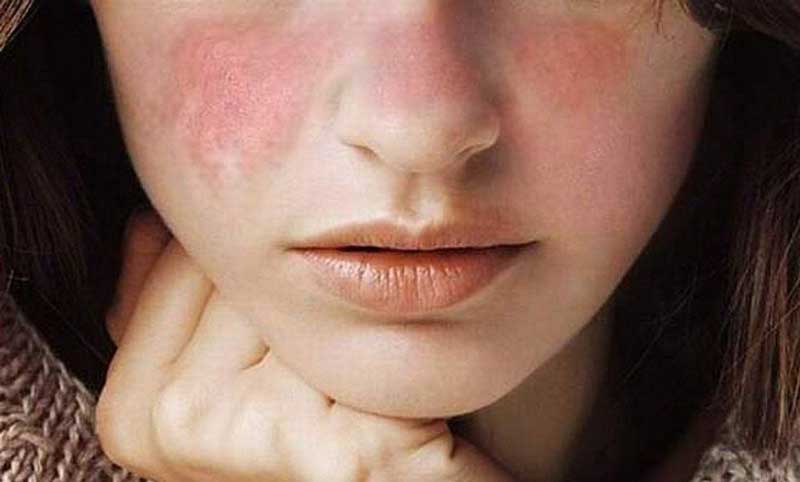 Hội chứng Sjogren là gì?