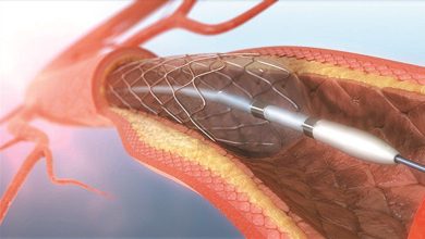 Khi nào bố tôi có thể xuất viện sau đặt stent mạch vành?