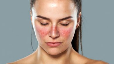 Mắc lupus ban đỏ có phải ung thư và tiên lượng sống như thế nào