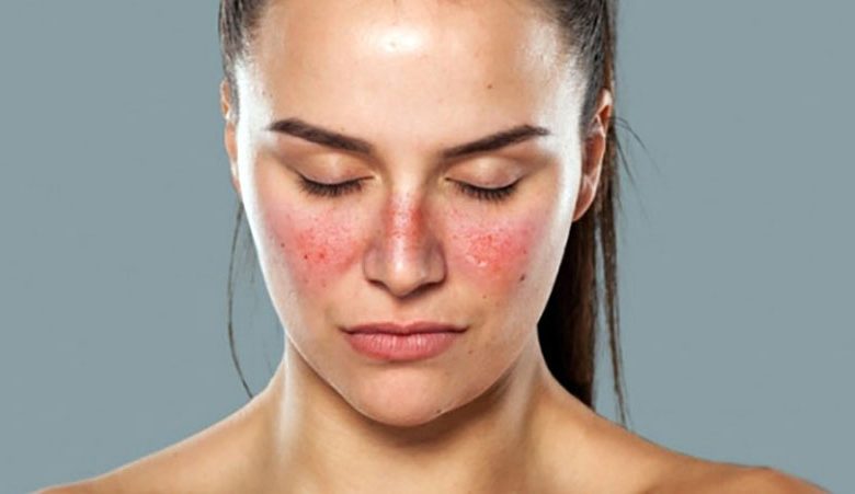 Mắc lupus ban đỏ có phải ung thư và tiên lượng sống như thế nào