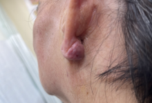 Cải thiện sẹo lồi bằng tiêm corticoid an toàn và hiệu quả