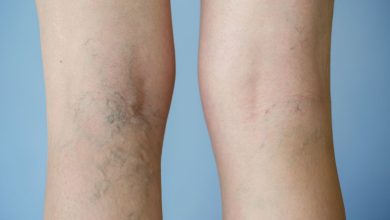 Tìm hiểu về suy giãn tĩnh mạch và cách phòng ngừa hiệu quả