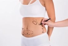 Nhiễm trùng rốn sau phẫu thuật tạo hình bụng: Nguyên nhân và điều trị