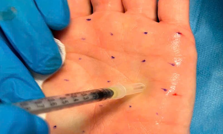 Giải pháp tiêm botox giảm đổ mồ hôi lòng bàn tay hiệu quả.