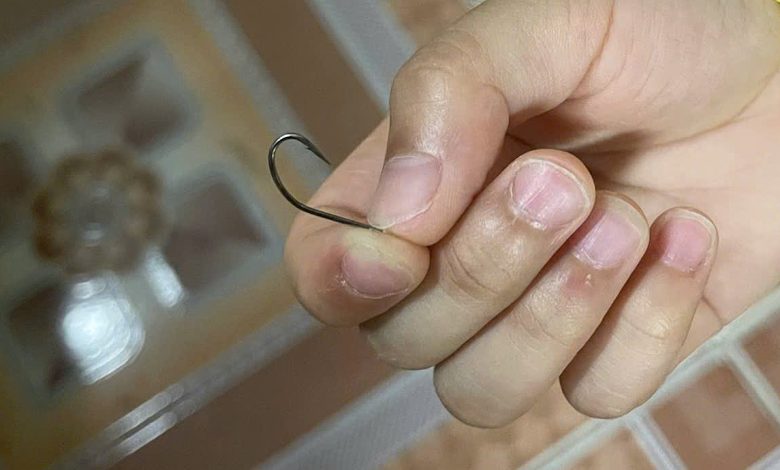 Cứu sống bé trai bị lưỡi câu đâm vào gáy