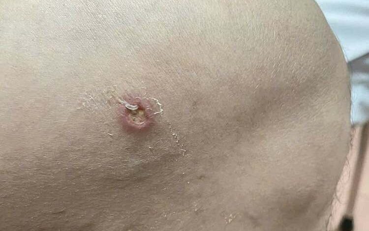 Phát hiện ca bệnh giun rồng thứ 26 tại Việt Nam