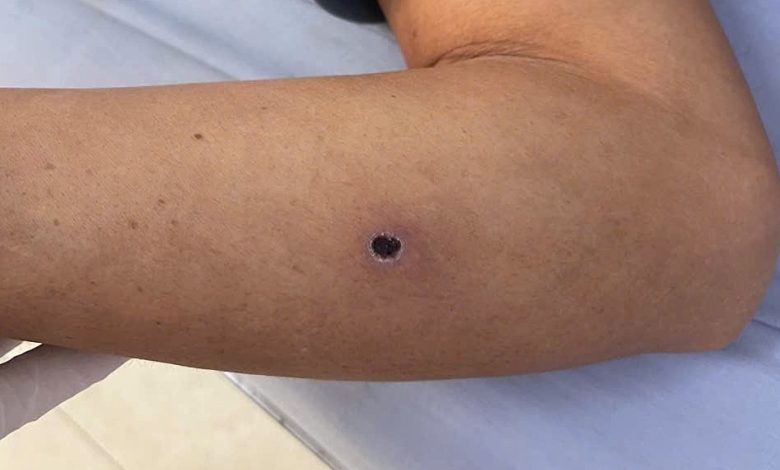 Phát hiện giun rồng ký sinh gây biến chứng nguy hiểm tại Việt Nam
