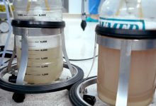 Rửa phổi thành công cho bệnh nhân mắc bệnh tích protein phế nang