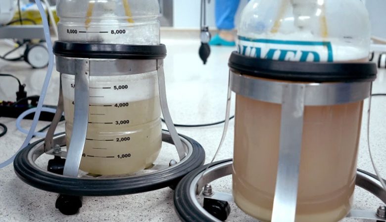 Rửa phổi thành công cho bệnh nhân mắc bệnh tích protein phế nang