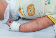 Trẻ mắc sởi nguy cơ cao mắc bệnh nặng hơn