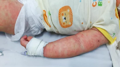 Trẻ mắc sởi nguy cơ cao mắc bệnh nặng hơn