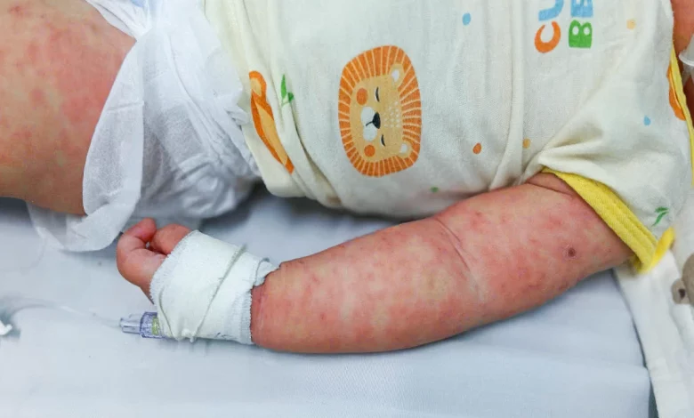 Trẻ mắc sởi nguy cơ cao mắc bệnh nặng hơn