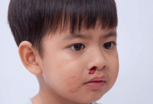 Chảy máu cam ở trẻ: Dấu hiệu cảnh báo ung thư máu